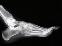 foot xray